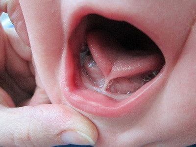 Tongue tie in babies: What you need to know | Babocush – Babocush Limited