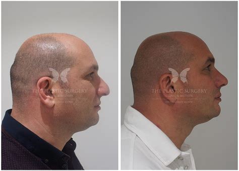 Rhinoplasty For Men Gallery The Plastic Surgery Clinic