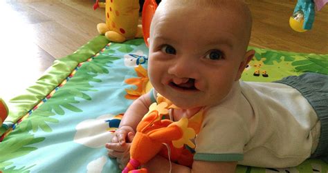 Cleft Lip And Palate Association