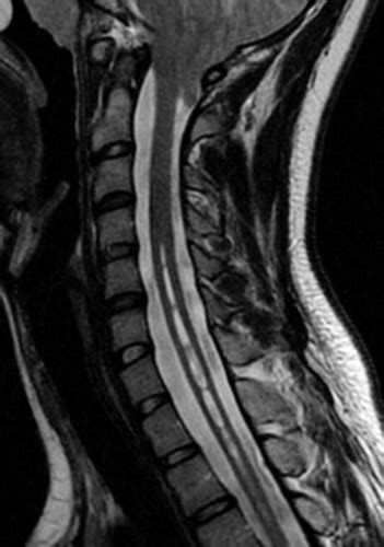 MMD1232 CM4 Myelopathies Part 2 Flashcards Quizlet