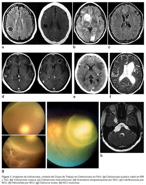 Diagnóstico y manejo de la neurocisticercosis en el Perú