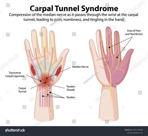 Diagram Showing Carpal Tunnel Syndrome Symptoms Royalty Free Stock