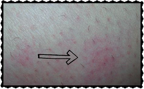 What do Bed Bug Bites Look Like - HubPages