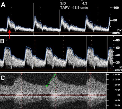 A Normal Doppler Spectrum With Spectral Window Indicated By Arrow