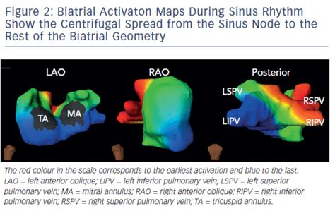 Figure 2 Biatrial Activaton Maps During Sinus RhythmShow The