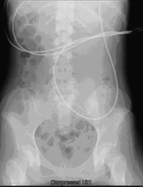 Supine Radiograph Of The Abdomen Showing Paucity Of Air And Mass Of Download Scientific Diagram