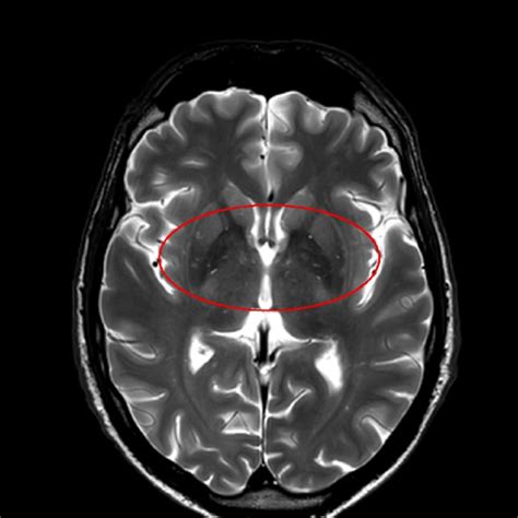 Cerebral Magnetic Resonance Imaging Sequence Turbo Spin Eco Sense Which