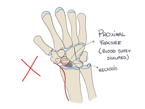 Scaphoid Fractures: how to not miss them - Pro doctor