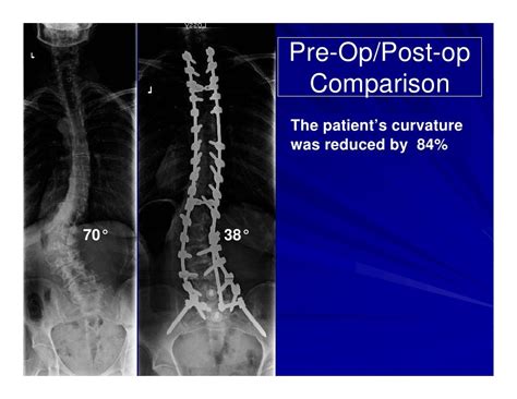 Case Review 11 Adult Idiopathic Scoliosis