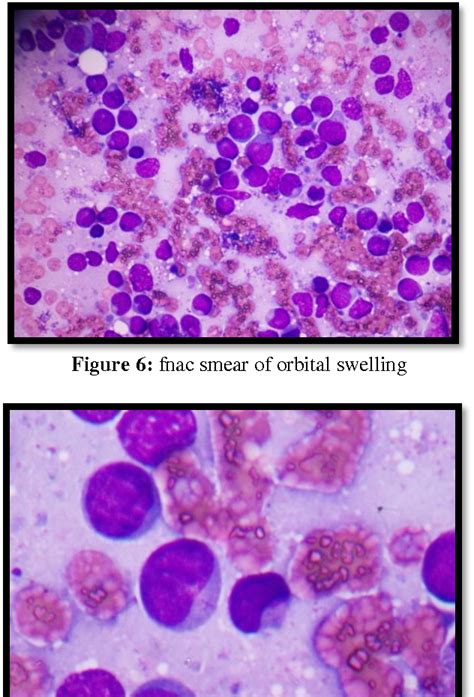 Figure 6 From A Rare Case Of Myeloid Sarcoma Presenting As Bilateral