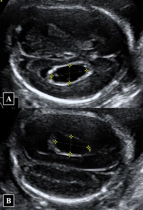 Choroid Plexus Ultrasound