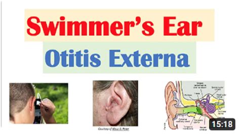 Swimmers Ear Symptoms Causes And When To Consult Your Primary Care