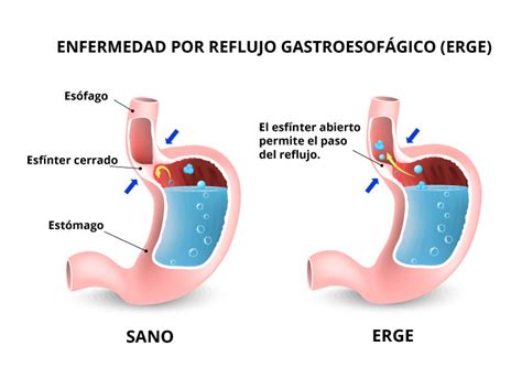 Salud Enfermedad Aparato Digestivo Enfermedad Por Reflujo