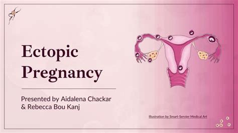 Ectopic Pregnancy Definition Triad Diagnosis And Treatment Ppt