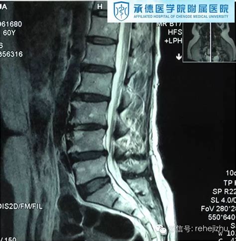 腰椎管狭窄症治疗新方法——椎间孔镜下单侧入路双侧减压 好大夫在线