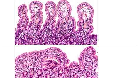 Coeliac disease - Diet Solutions