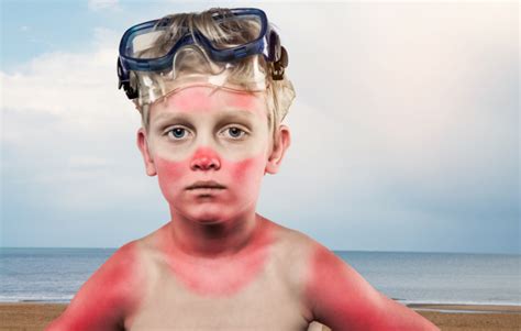 Sunburn - Premier Pediatrics