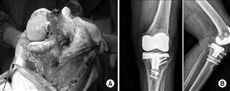 Figure 2 From Conversion Of Total Knee Arthroplasty After High Tibial