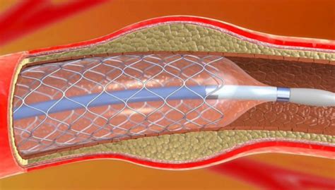 Angioplastia