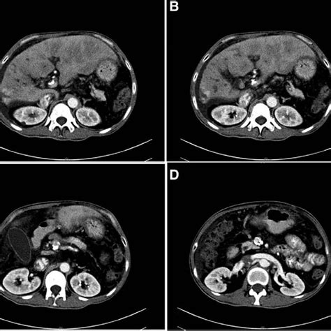 The Contrast Enhanced Ct Of The Abdomen Of Patient A And B Enhanced Download Scientific