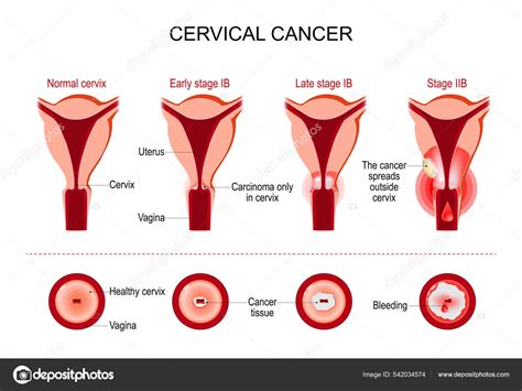 Cervical Cancer Cervix Carcinoma Development Stage Vector Illustration