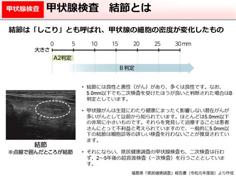 環境省甲状腺検査 結節とは