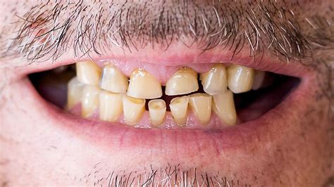 Signs Of Tooth Abrasion How To Prevent It