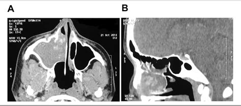 Figure From Maxillary Sinus Lobular Capillary Hemangioma In A Year