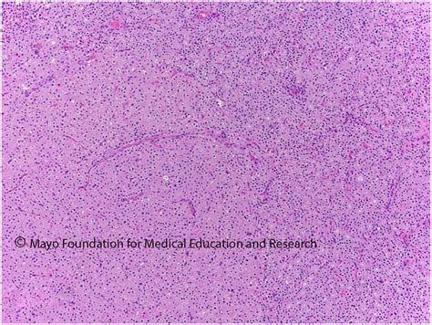 Oncocytic Parathyroid Adenoma Mayo Clinic Proceedings