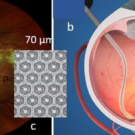 A View Of The Retina With Its Implant B Subretinal Insertion