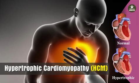 Exploring Hypertrophic Cardiomyopathy Symptoms And Treatments