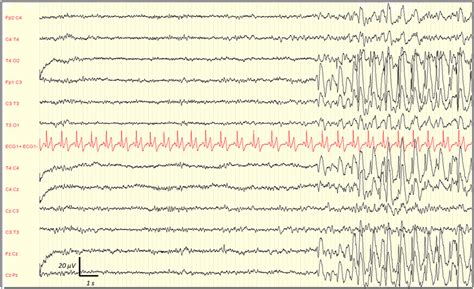 Representative Example Of EEG Showing The Onset Of An Electrographic