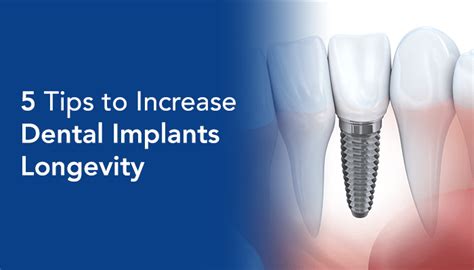 5 Tips To Increase Dental Implants Longevity Vistadent