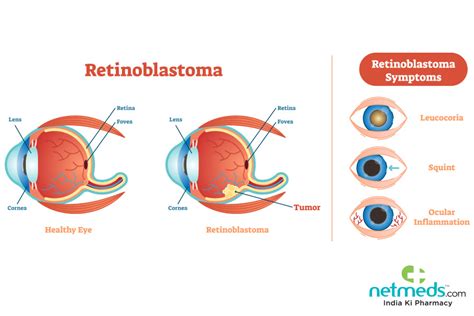 Retinoblastoma: Causes, Symptoms And Treatment