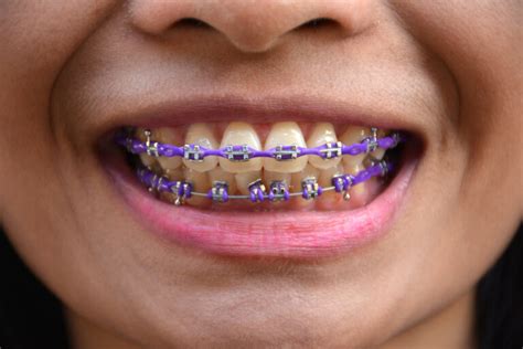 Is Purple a Good Color for Braces? - The Braces Guide