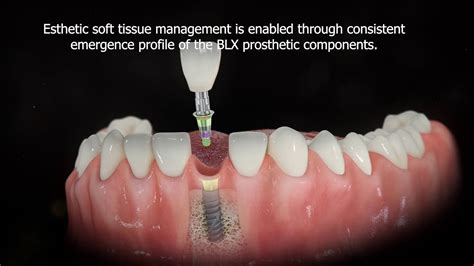 Straumann® Blx Implant System Consistent Emergence Profile Youtube