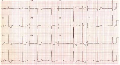 Digoxin Toxicity Signs And Symptoms Causes Ecg Diagnosis And Treatment