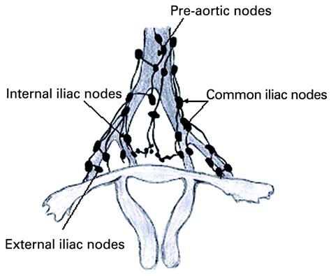 Assessment Of Sentinel Lymph Node In Cervical Cancer Review Of