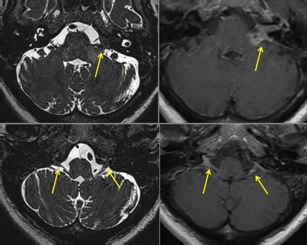 9th Cranial Nerve Mri