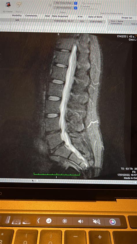 MRI Results - Annular Tear and Mild Bulges Advice Please : r/backpain