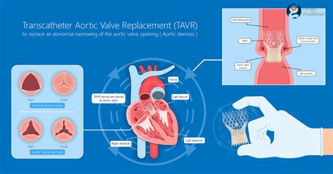 Aortic Valve Replacement Purpose Preparation Procedure And Risks