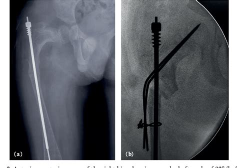 Figure 1 from Coxa vara surgery for osteogenesis imperfecta. A report ...