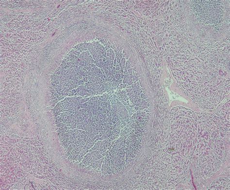 Systemic Candidiasis Radiographics