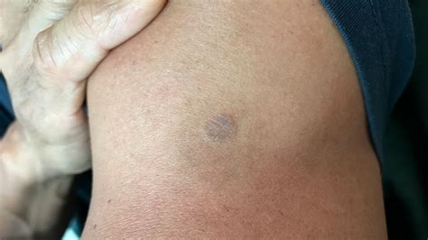 What Causes Brown Crusty Spots On Skin