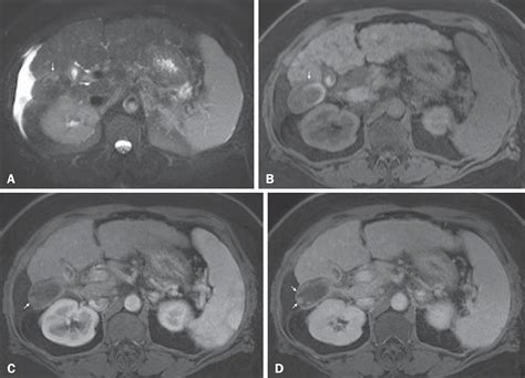 Scielo Brasil Magnetic Resonance Imaging Of The Cirrhotic Liver