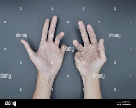 Deformierte Hand Stockfotos und -bilder Kaufen - Alamy