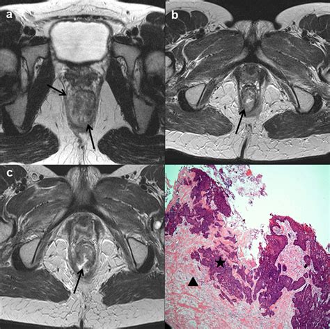 High Resolution Axial T2 Weighted Images A C Baseline Magnetic