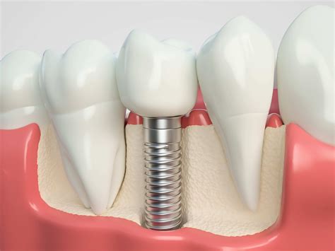 Understanding Dental Bone Graft: Process, Healing & What It Is | 360