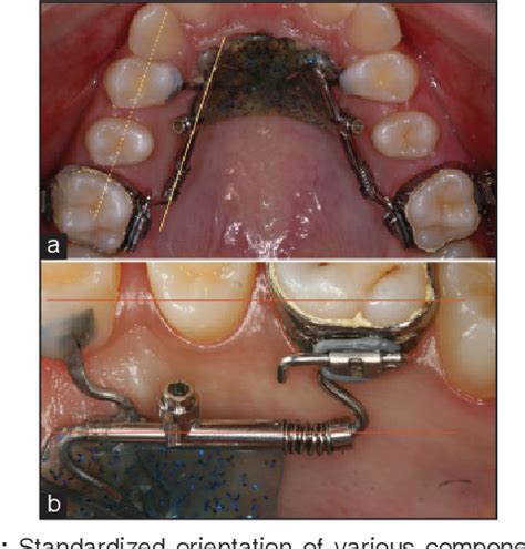 Figure From Evaluation Of Treatment Changes Associated With Maxillary