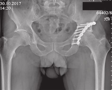 Anteroposterior View Of The Pelvis And The Hip Joints Of Patient P